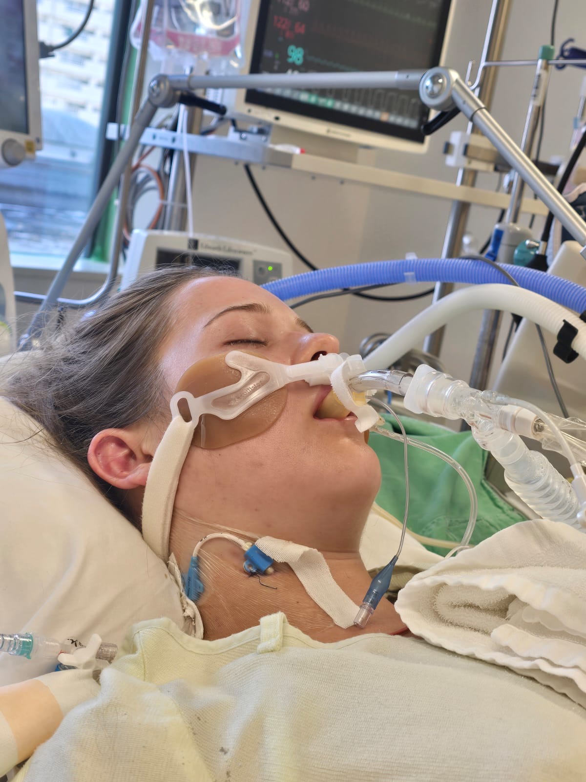 Anna was intubated and fully sedated for five days 